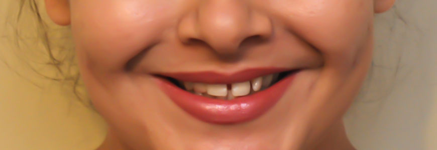 Gaps between Teeth